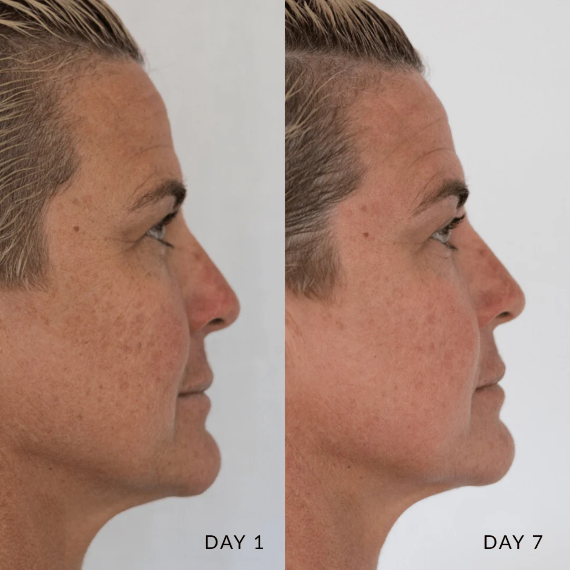 Side-by-side Glory Cream comparison of a person's face before and after a procedure on Day 1 and Day 7.